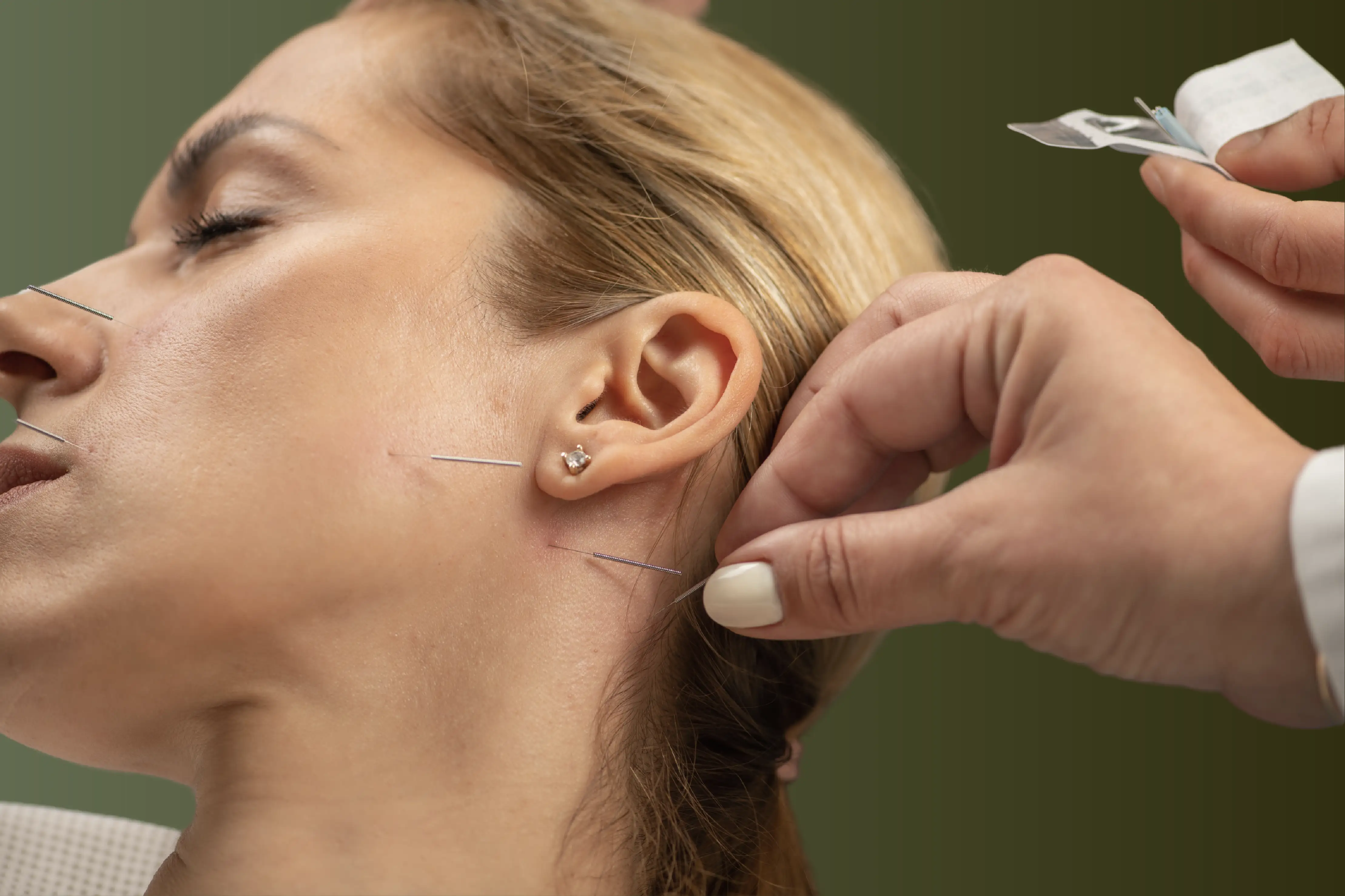 Cosmetic Acupuncture