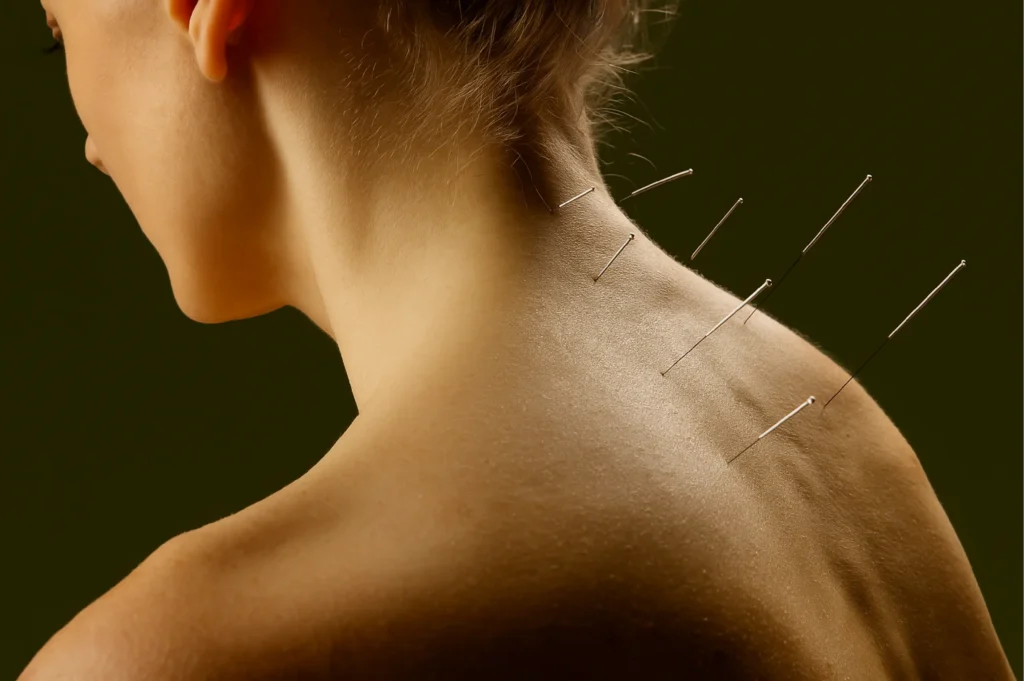 Acupuncture treatment at Myocare RMT Toronto