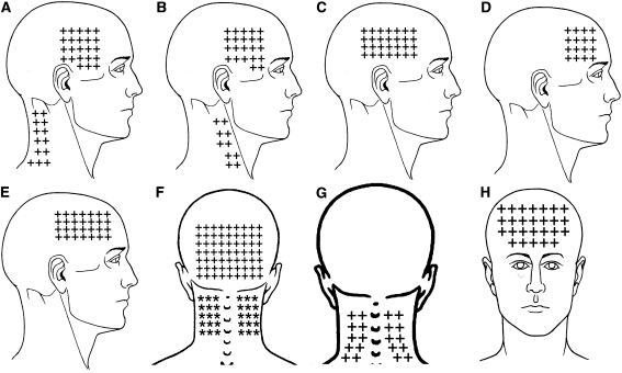 Diagram of headache trigger points in the upper trapezius, SCM, temporalis, masseter, suboccipital, levator scapulae and superior oblique muscles showing where each refers pain